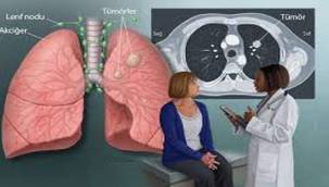 Akciğer kanseri kadınlarda da artıyor