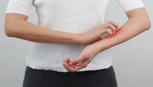 Soğuk Hava Ve Rüzgar egzamayı Tetikliyor! 